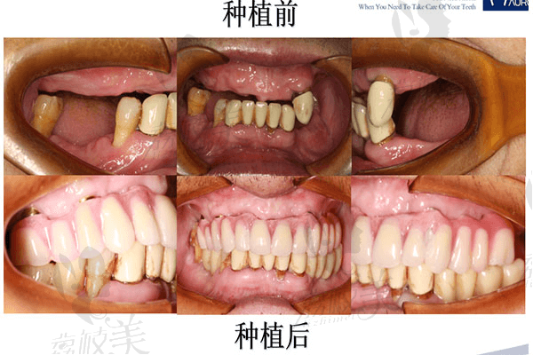 成都极光口腔牙齿种植案例