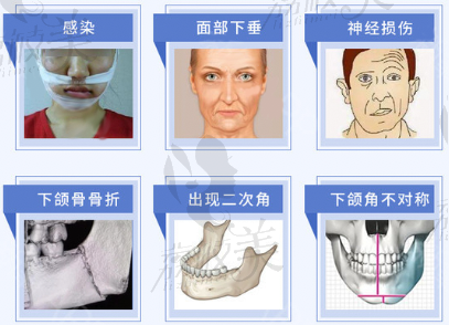 下颌角术后6大病发症