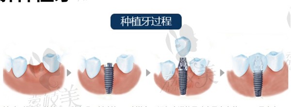 牙齿种植过程