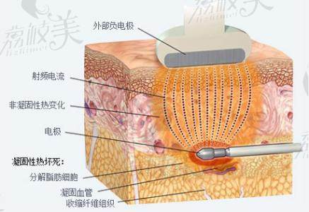 黄金射频和分层吸脂原理