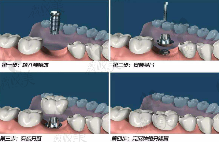 种植牙过程