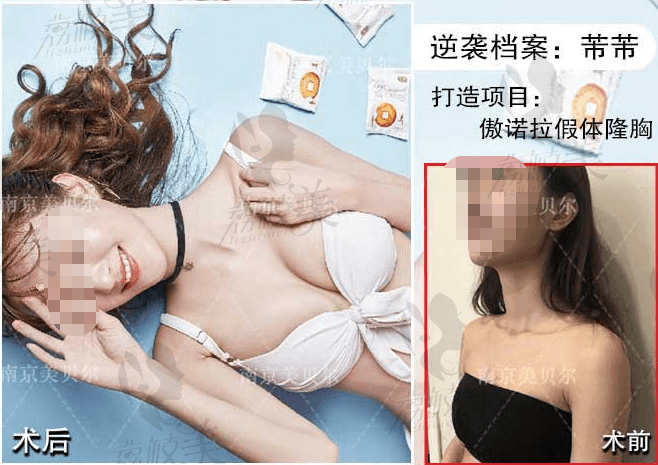 南京美贝尔傲诺拉假体隆胸案例