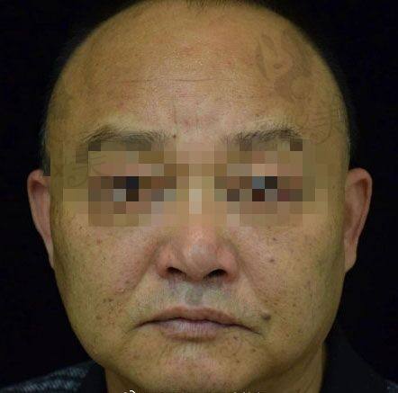 深圳香蜜丽格黎京雄净肤祛斑治疗全过程案例图