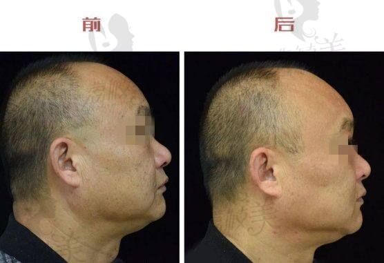 深圳香蜜丽格黎京雄净肤祛斑治疗全过程案例图