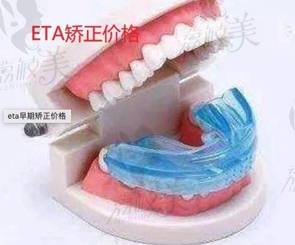 ETA儿童早期矫治器