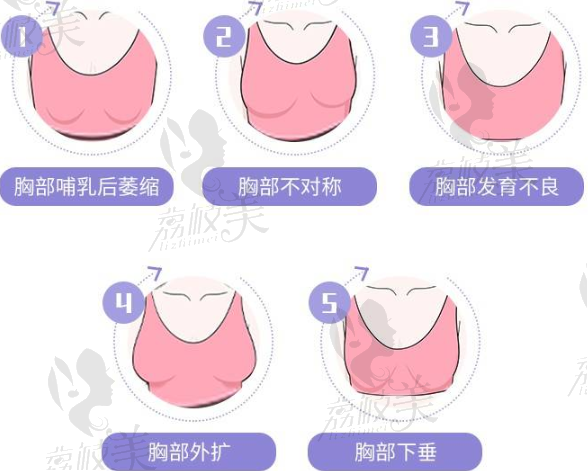 适合做假体隆胸的类型