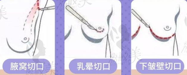 假体隆胸切口