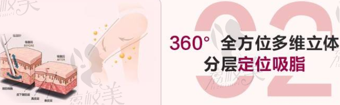 郑州集美360°多维立体分层吸脂