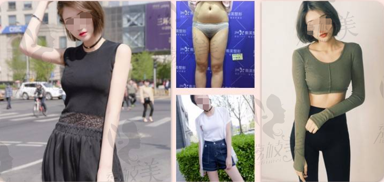 郑州集美多维立体吸脂案例