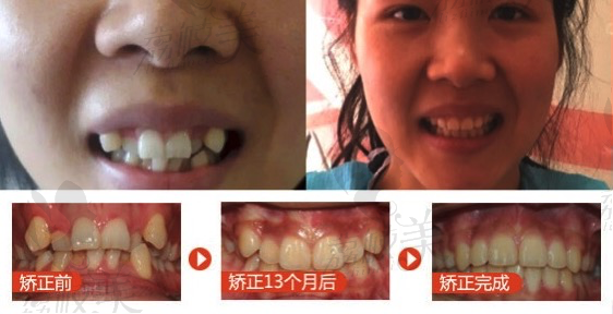 来看看厦门麦芽口腔王欢医生牙齿矫正的案例效果怎么样？
