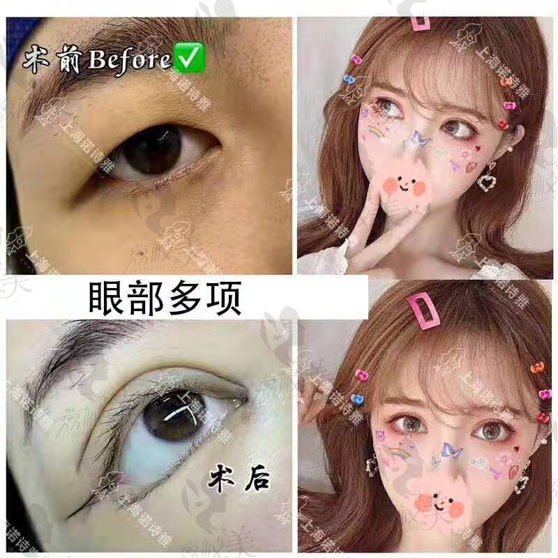上海诺诗雅眼综合(NSY十度美眼术灵动隐痕妈生双眼皮案例图