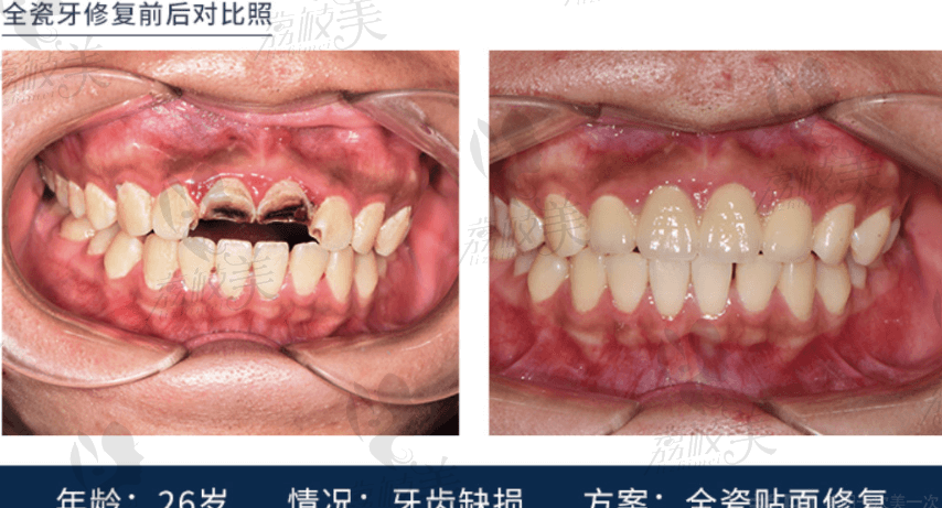 重慶牙博士口腔全瓷牙修復<span style=