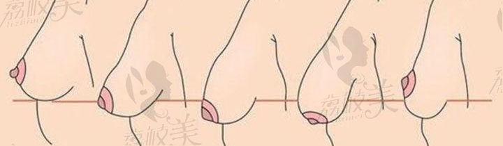 假体隆胸水滴和圆形哪个好看?看沈阳刘金超术后乳房效果图
