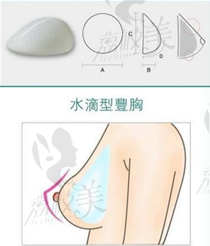 假体隆胸水滴和圆形哪个好看?看沈阳友谊整形刘金超术后乳房效果图