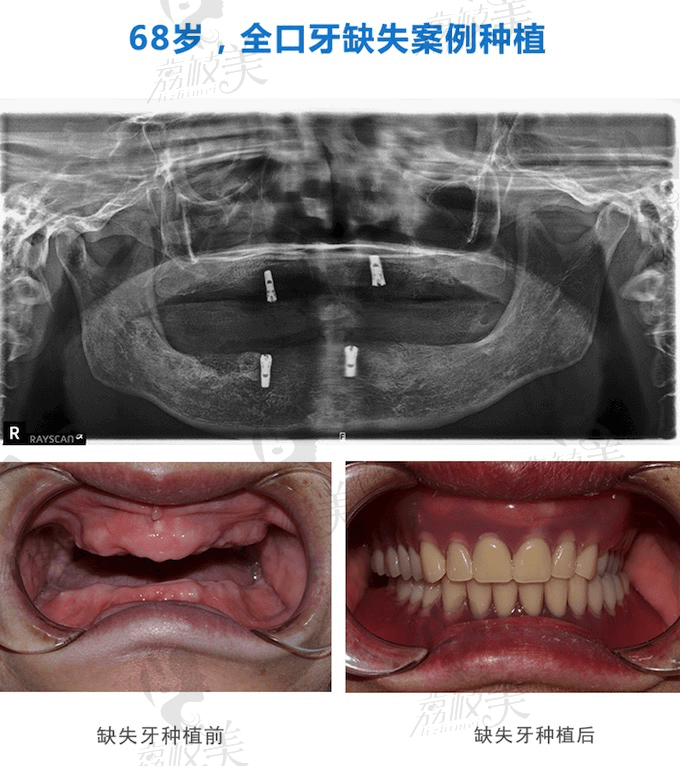 四川华西口腔宫萍医生All-on-4全口种植牙案例分享