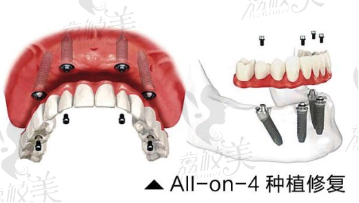 四川华西口腔医院All-on-4即刻负重技术