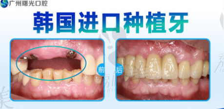 廣州曙光口腔種植牙案例分享  