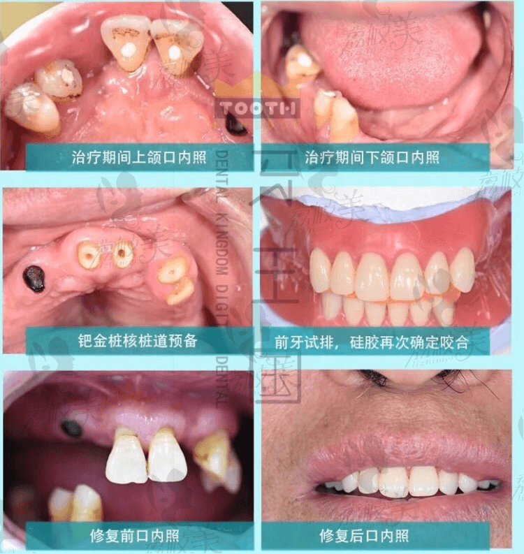 兰州牙王国曹福春医师红白美学案例