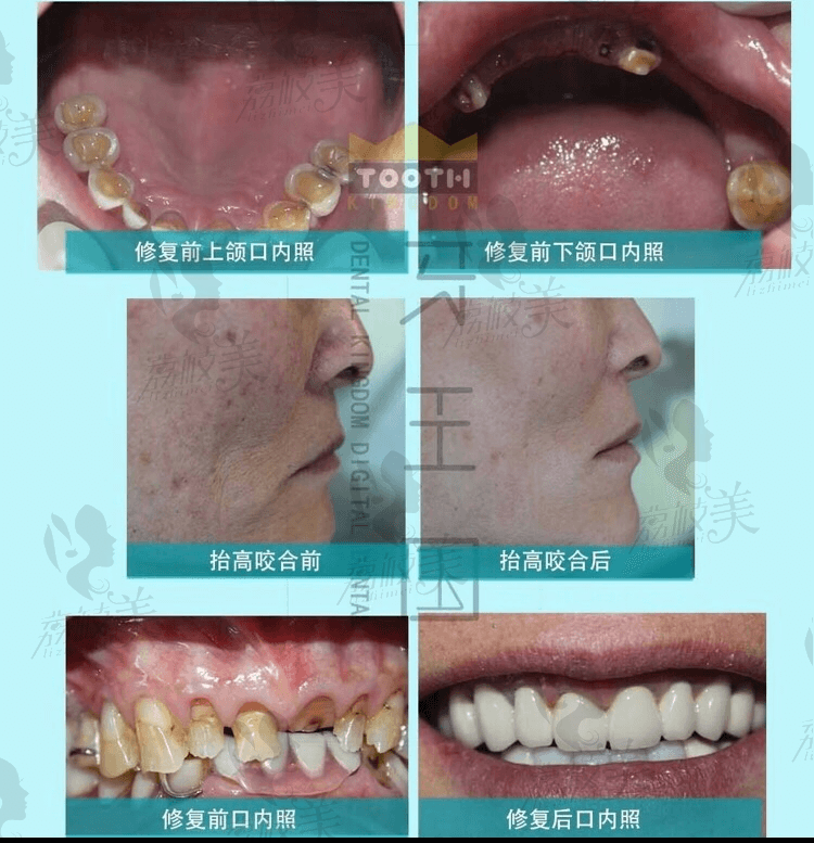 兰州牙王国曹福春医师红白美学