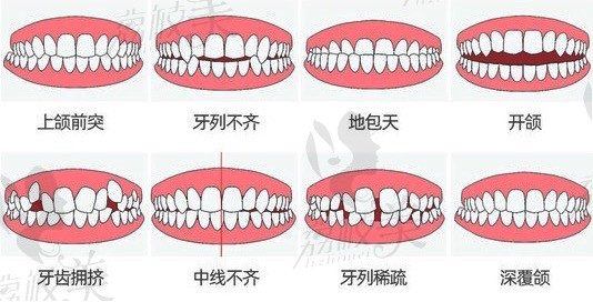 哪些人需要做牙齿矫正？