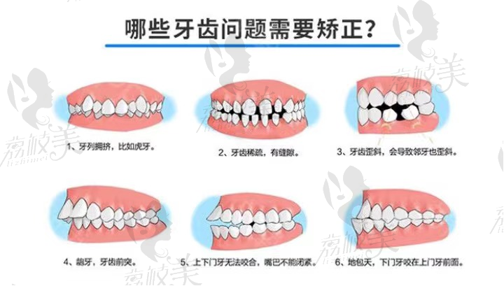 兰州牙王国金属托槽矫正