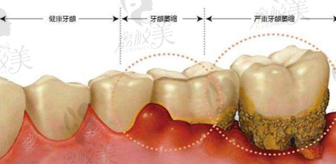 牙龈萎缩可以种植牙齿吗？