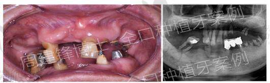 北京京一口腔周建峰医生种植案例