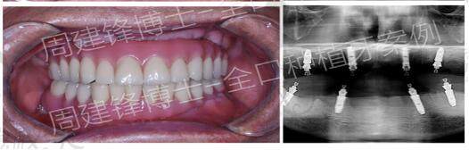 北京京一口腔周建峰一身种植案例