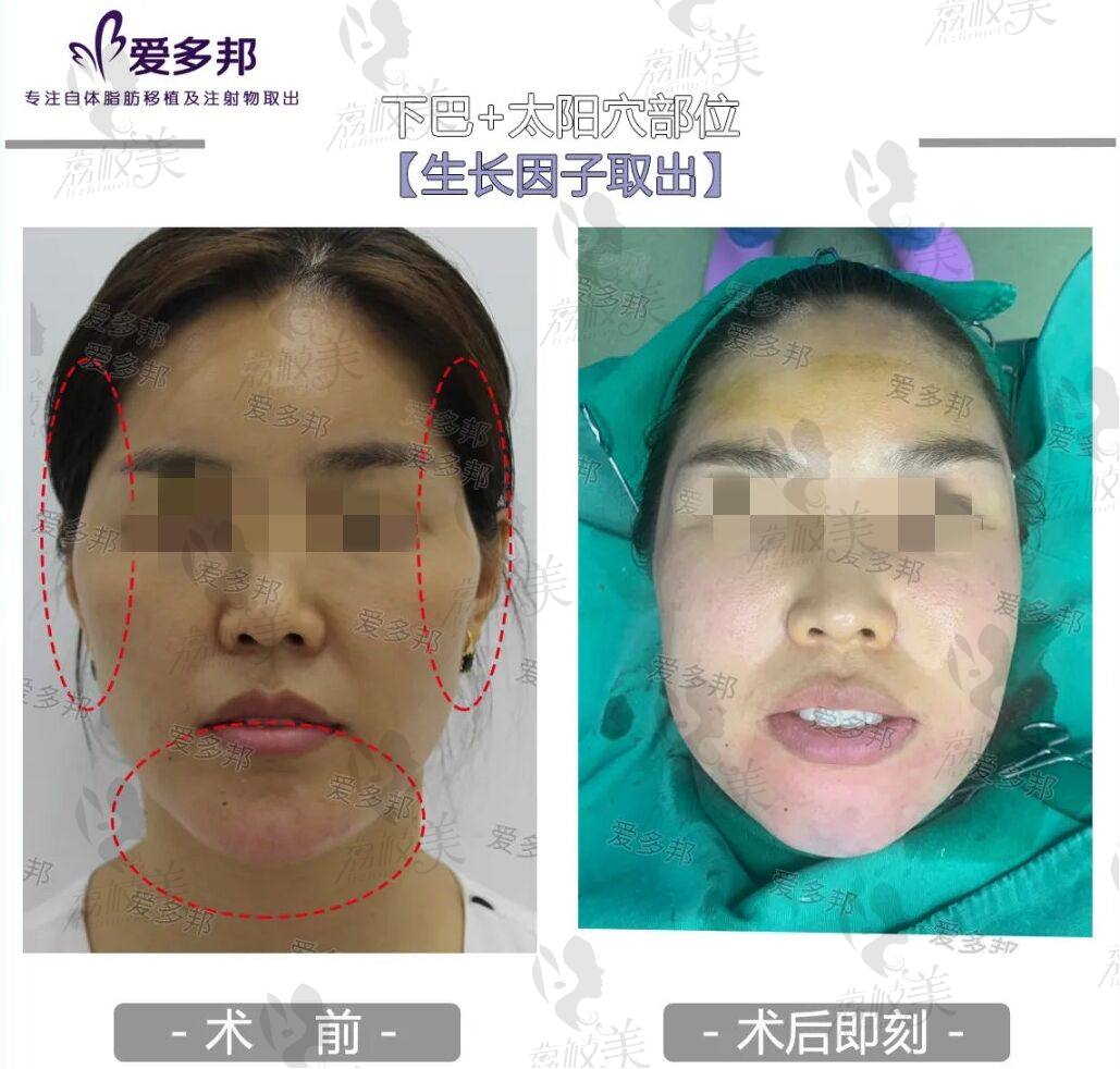 下巴注射生长因子3年了-取出修复后3个月的恢复效果图对比!