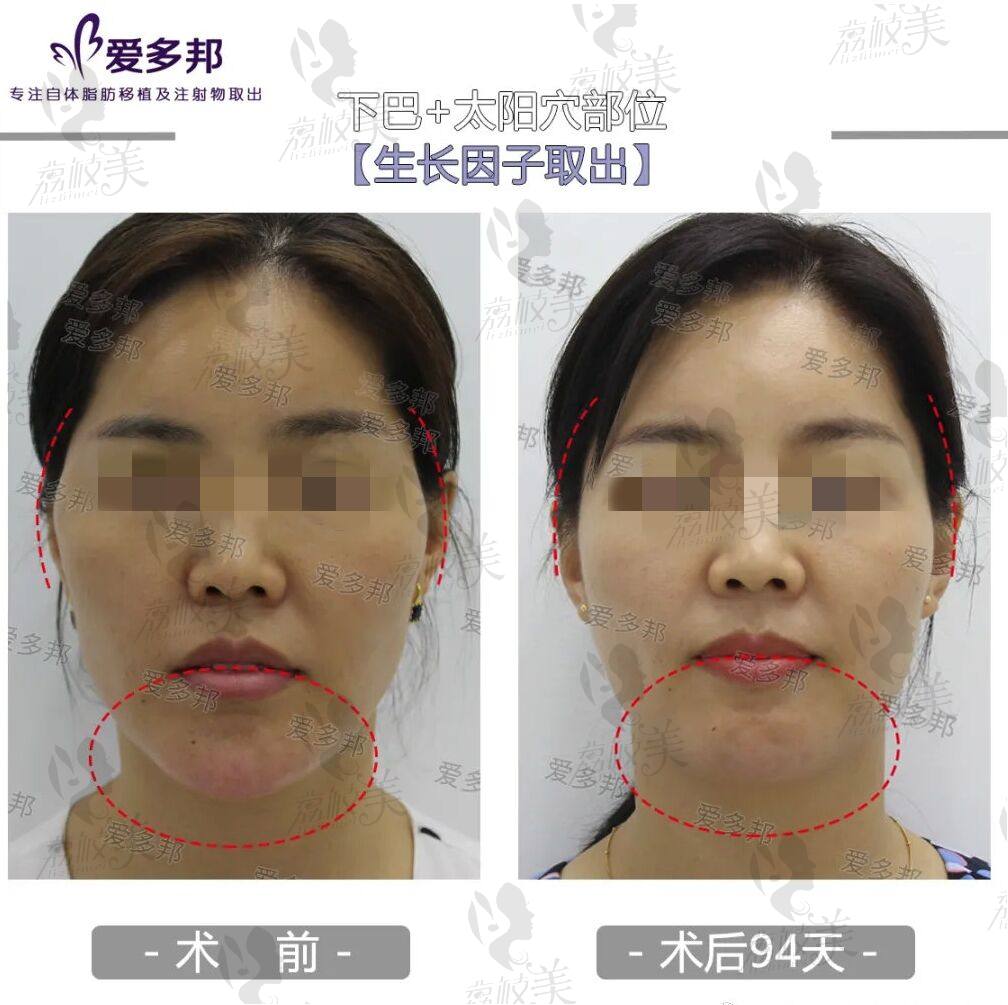 下巴注射生长因子3年了-取出修复后3个月的恢复效果图对比!
