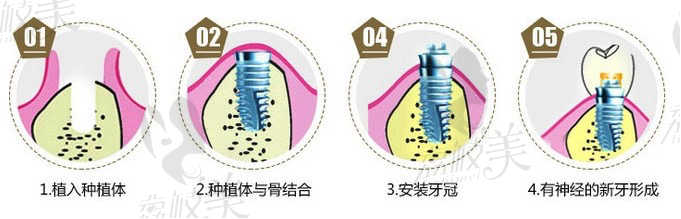 即刻种植修复技术优势