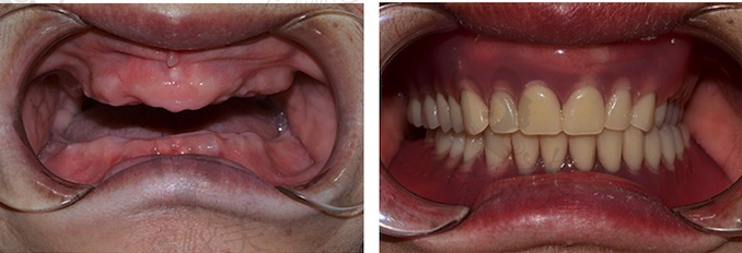 长沙牙祖口腔周磊院长超微创种植牙案例