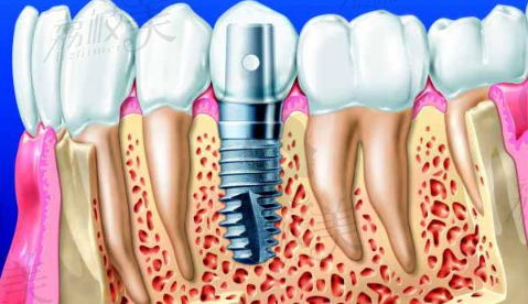 种植牙