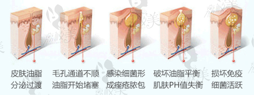 造成面部痘痘的原因