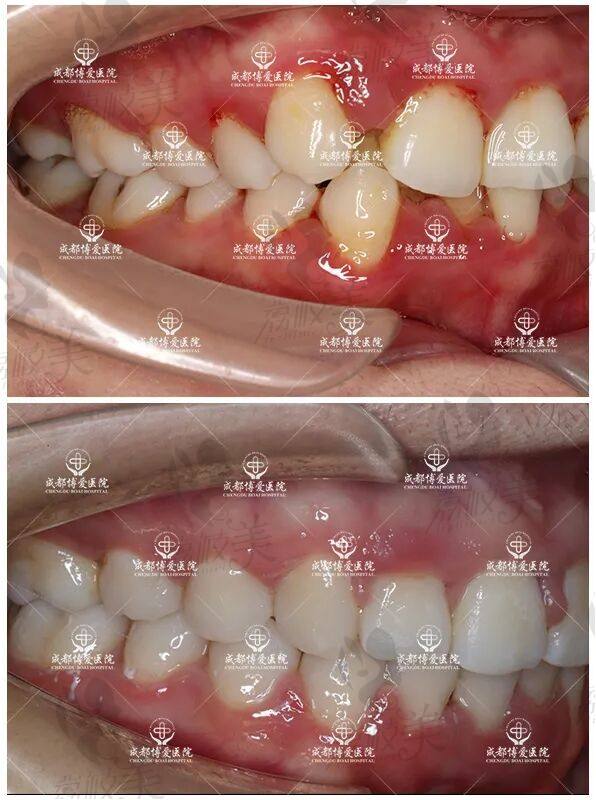 成都博爱口腔正畸案例