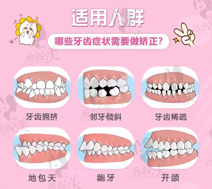 广州穗江口腔可丽尔隐形牙齿矫正适用人群