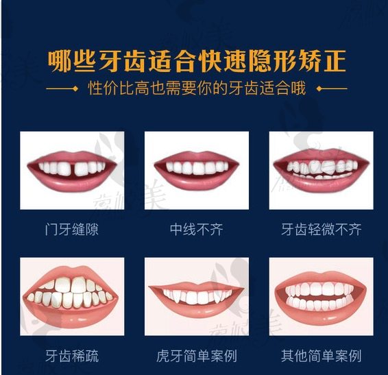 上海永华口腔快速隐形矫正牙齿