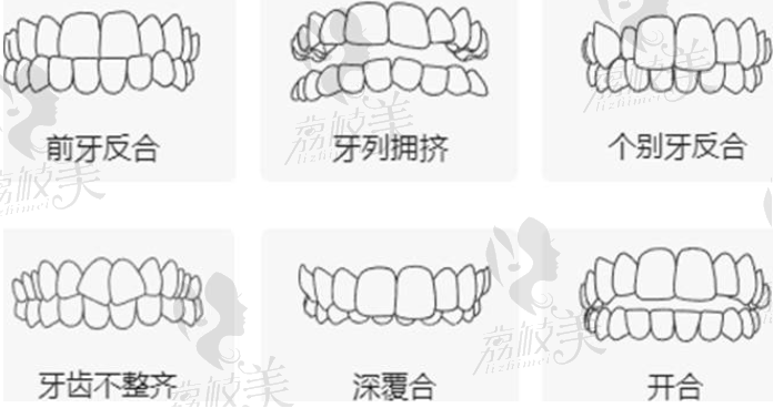 牙齿矫正类型