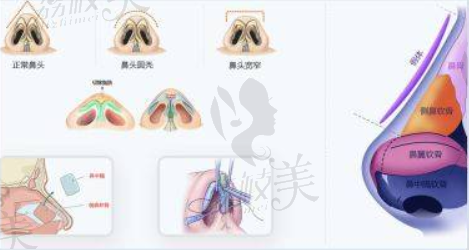 鼻基底稳固减少滑动