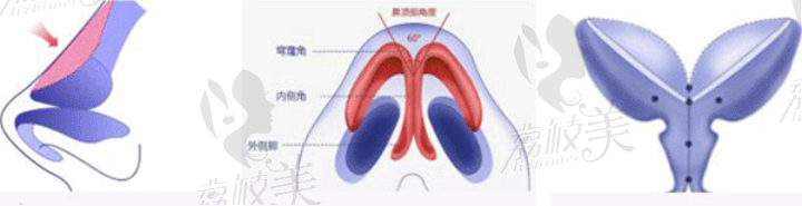 鼻基底肋骨、假体、脂肪填充优势