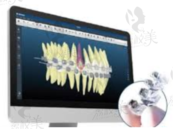 3D数字化牙齿矫正