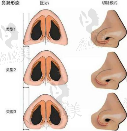 上海百达丽三种鼻翼缩小切除方式