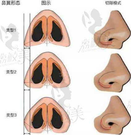 上海百達(dá)麗三種鼻翼縮小切除方式