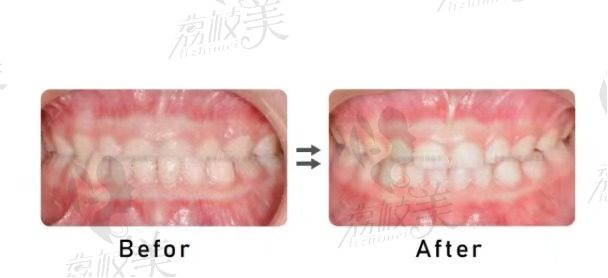 深圳慈恩牙齒矯正歪牙正畸方案設(shè)計(jì)