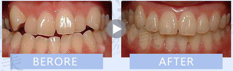 重庆齐美口腔隐形托槽矫正真人案例