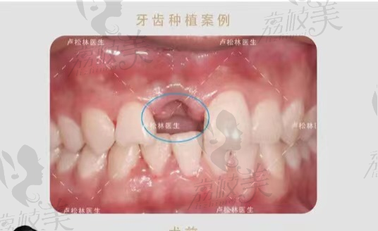 深圳慈恩齿科#韩国奥齿泰种植牙案例