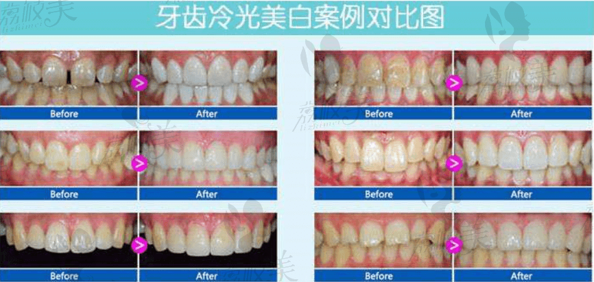 安慶貝爾口腔360°冷光美白案例