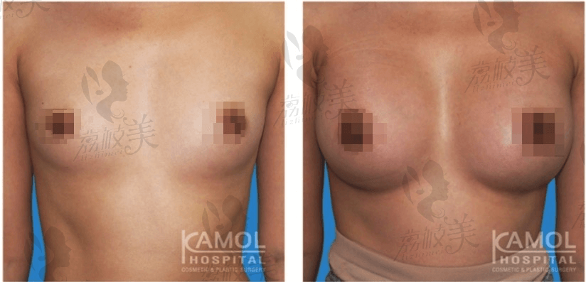 泰国伽蒙（kamol）整形MTF隆胸术案例