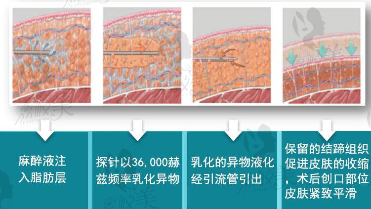 北京艾瑪醫(yī)療美容診所內(nèi)窺鏡取出異物