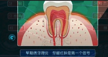 牙周疾病的早期症状有哪些？